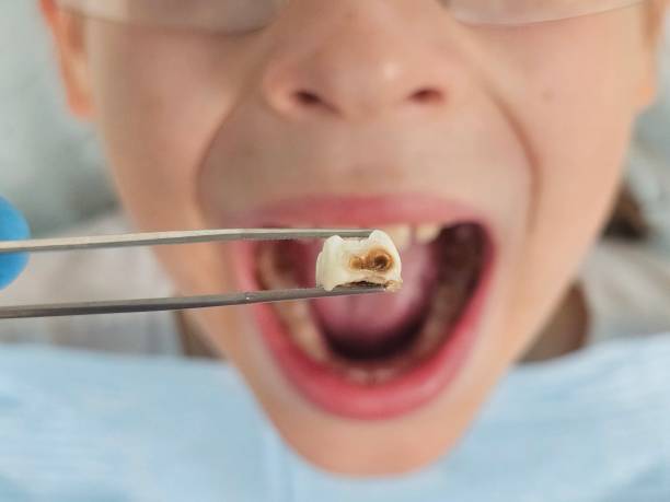 Best Same-Day Emergency Dental Services in Boyce, LA